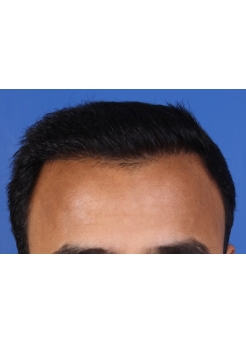 After Hair Transplant&nbsp;Front